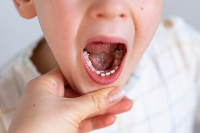 Children shark teeth, first tooth that appears in childhood behind baby teeth.